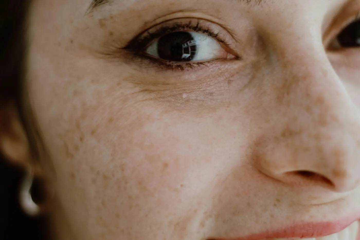 Facial skin image representing melasma and pigmentation treatment