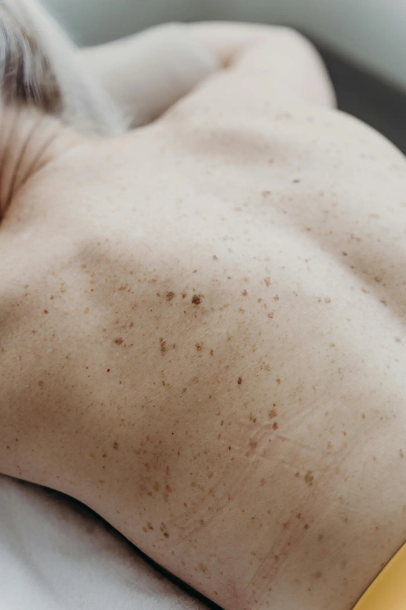 Dermatology skin check image representing skin cancer screening and prevention